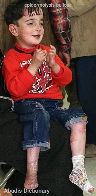 epidermolysis bullosa